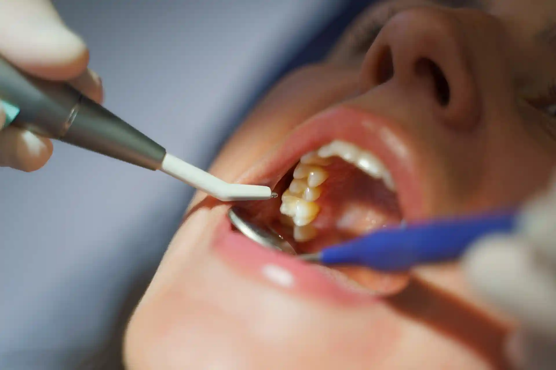 close up of dental examination for new filling