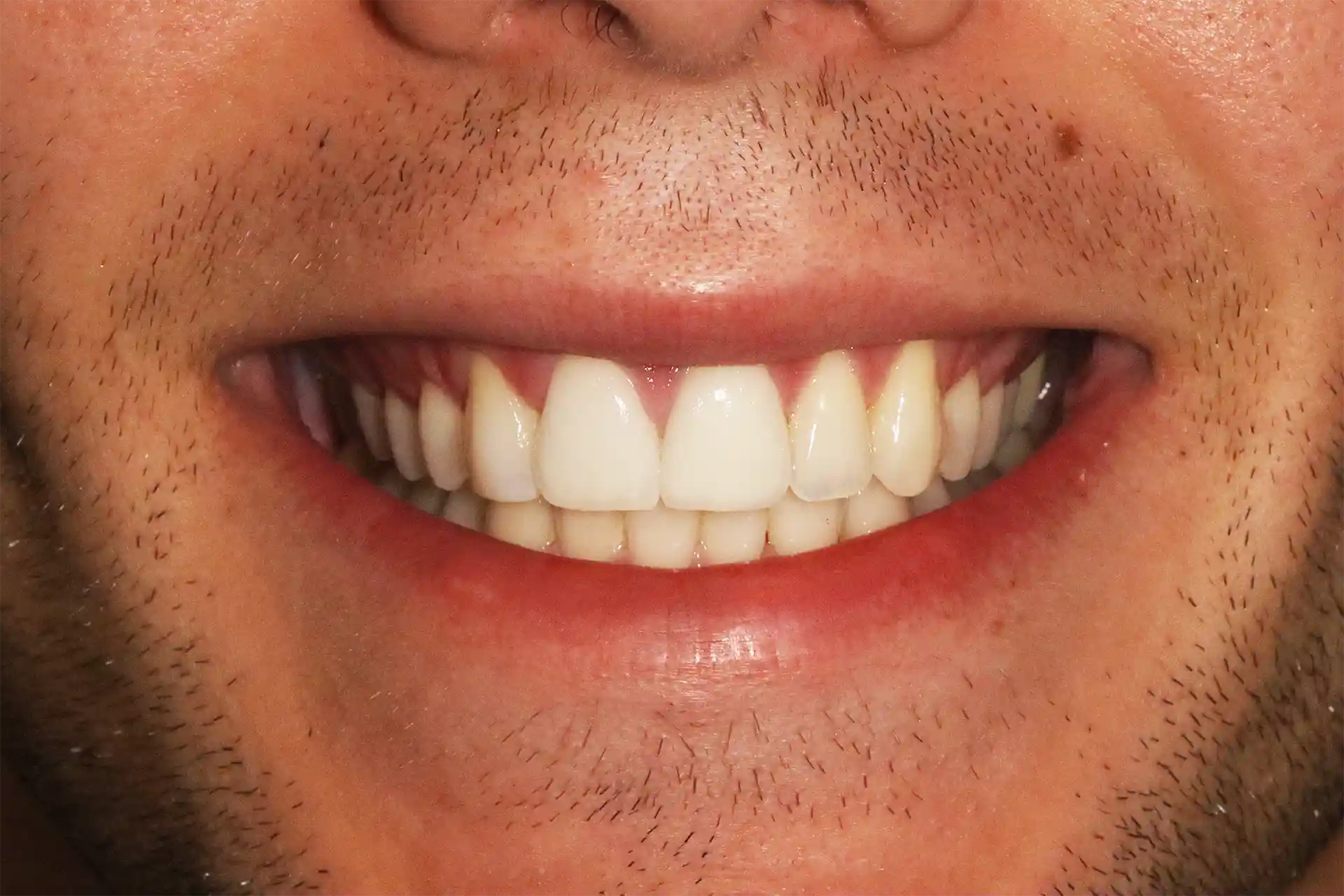 After composite veneers treatment