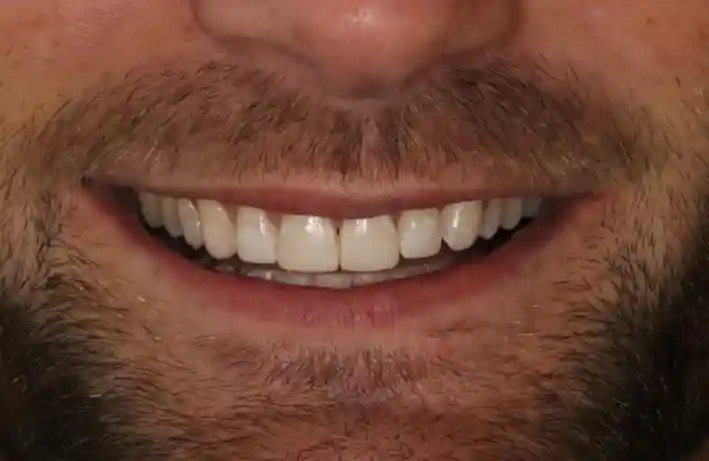Chipped or Cracked Tooth Repair After