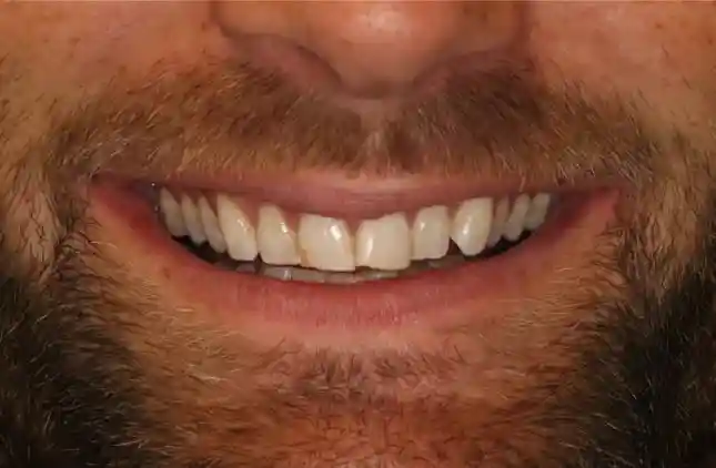 Chipped or Cracked Tooth Repair Before