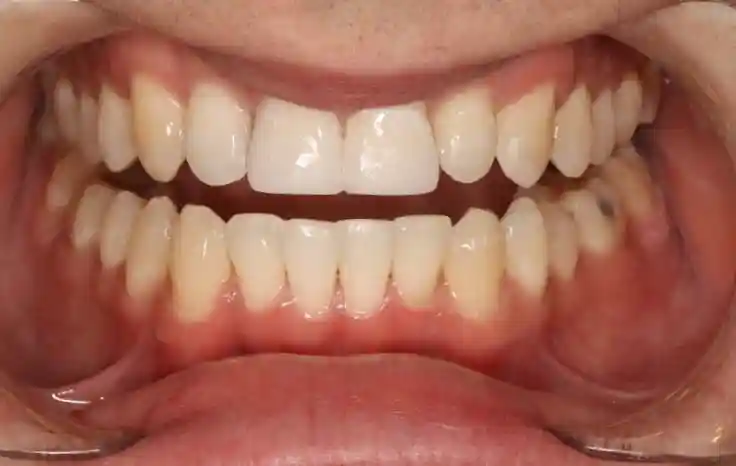 Crooked Teeth & Teeth Straightening Options After