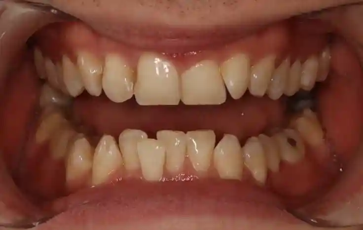 Crooked Teeth & Teeth Straightening Options Before