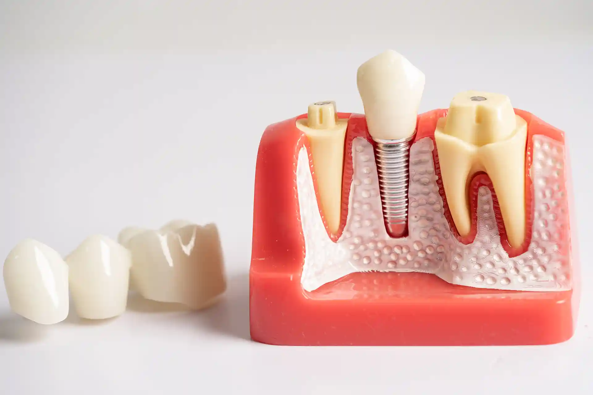 dental implant tooth display