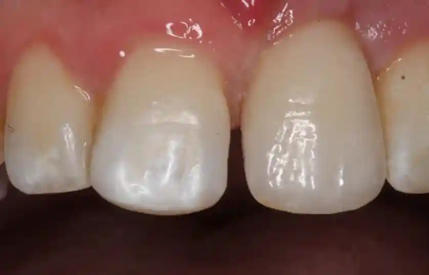 Emergency Dental Trauma Care After