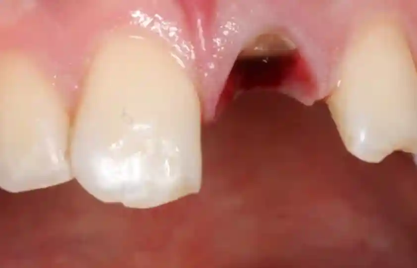 Emergency Dental Trauma Care Before