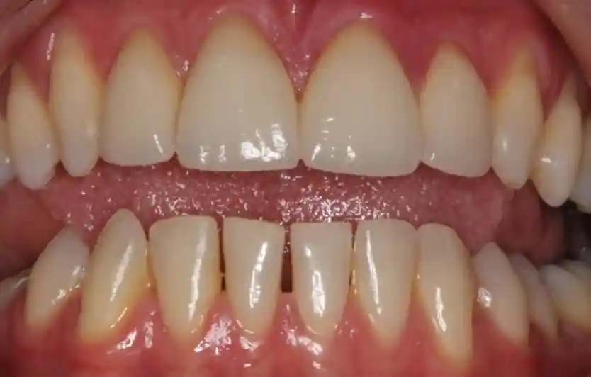 Gaps Between Teeth After