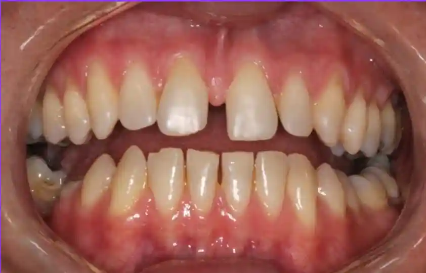 Gaps Between Teeth Before