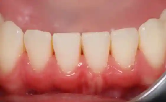 Gum Disease Treatment & Bleeding Gums After
