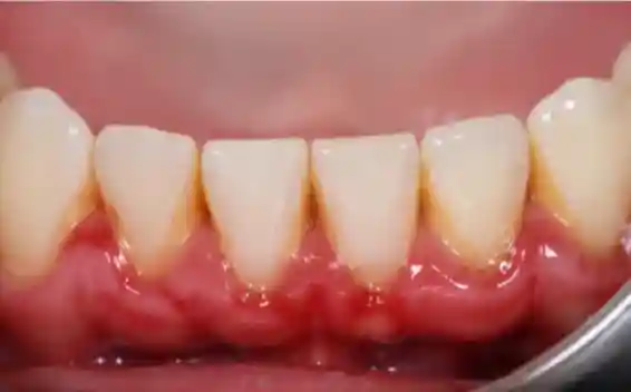 Gum Disease Treatment & Bleeding Gums Before