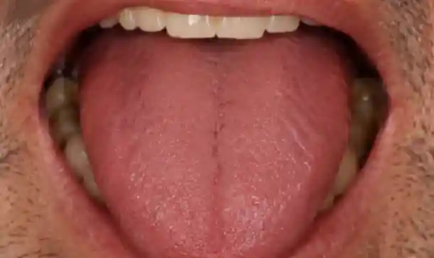Halitosis After Treatment