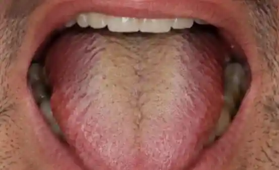 Halitosis Before Treatment