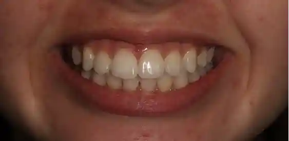 smile after teeth whitening