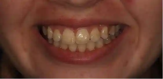 smile before teeth whitening
