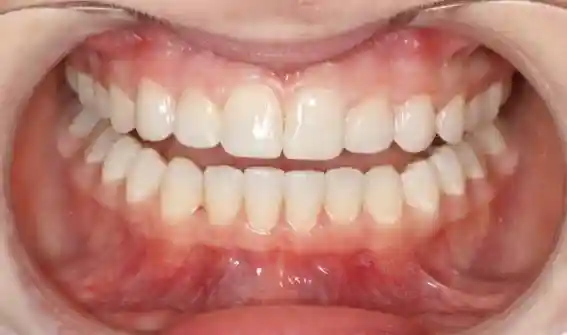 White Spots on Teeth & Fluorosis Treatment (ICON) After