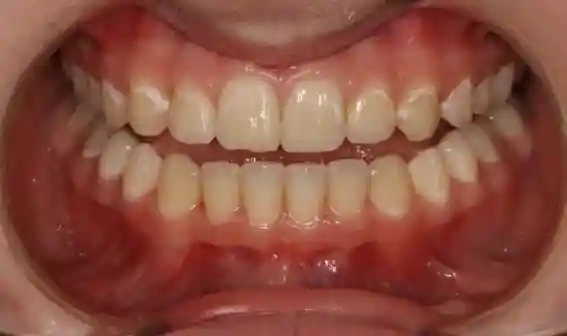 White Spots on Teeth & Fluorosis Treatment (ICON) Before