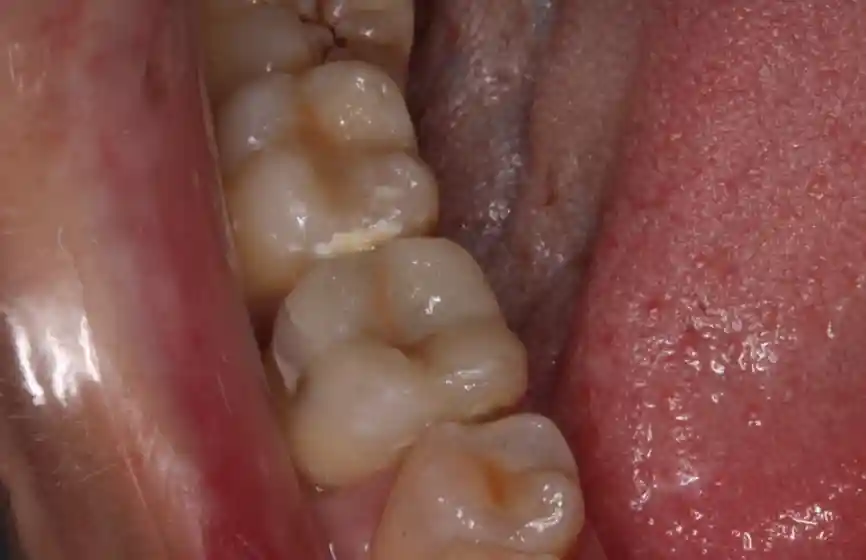 composite filling after treatment