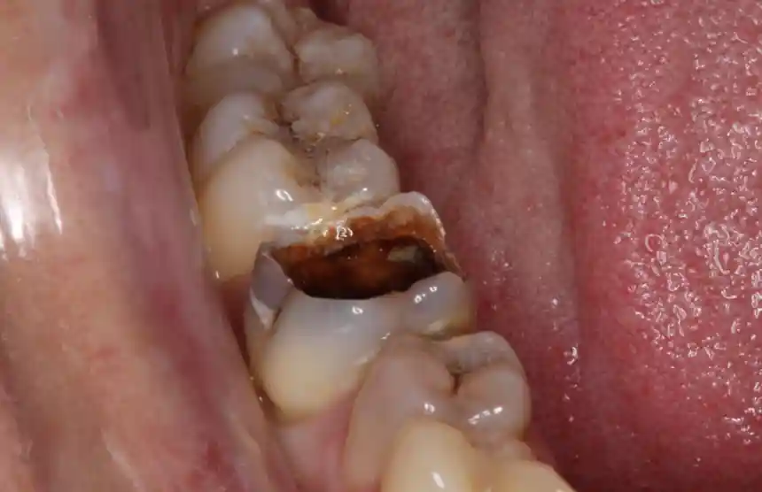 composite filling before treatment