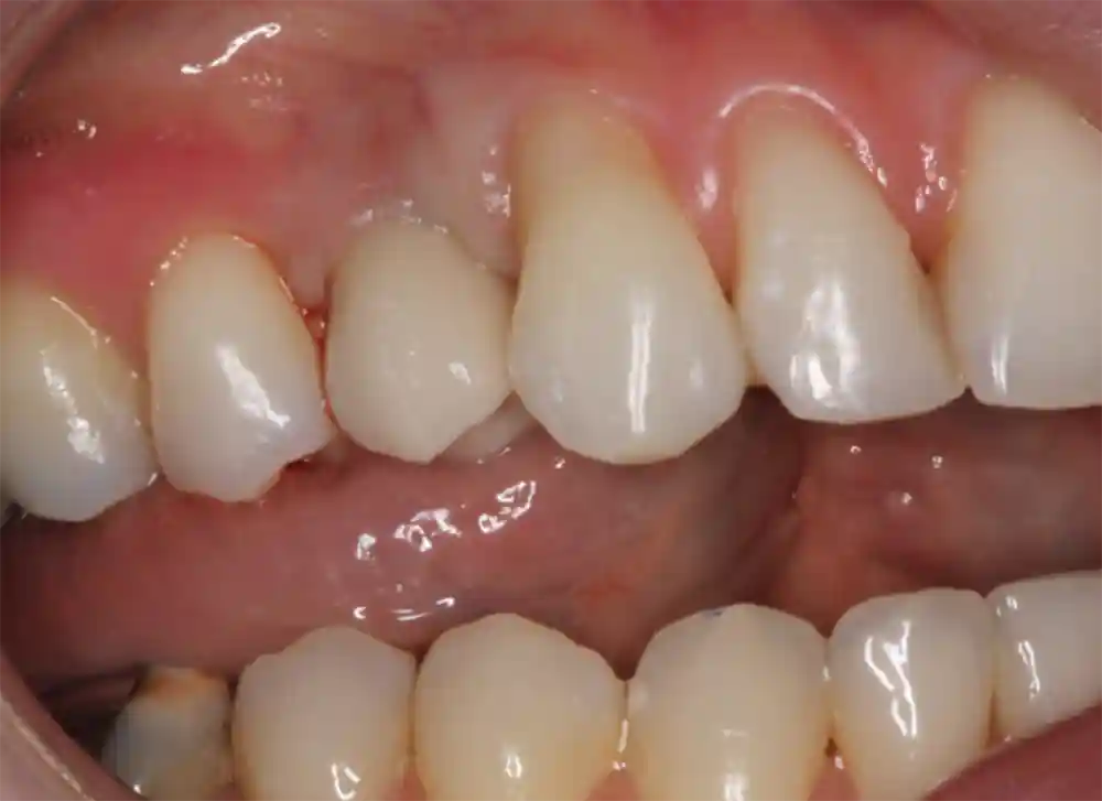 dental implant after treatment