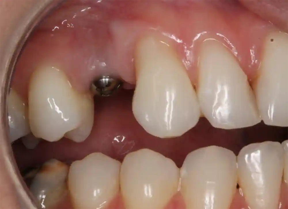 dental implant before treatment