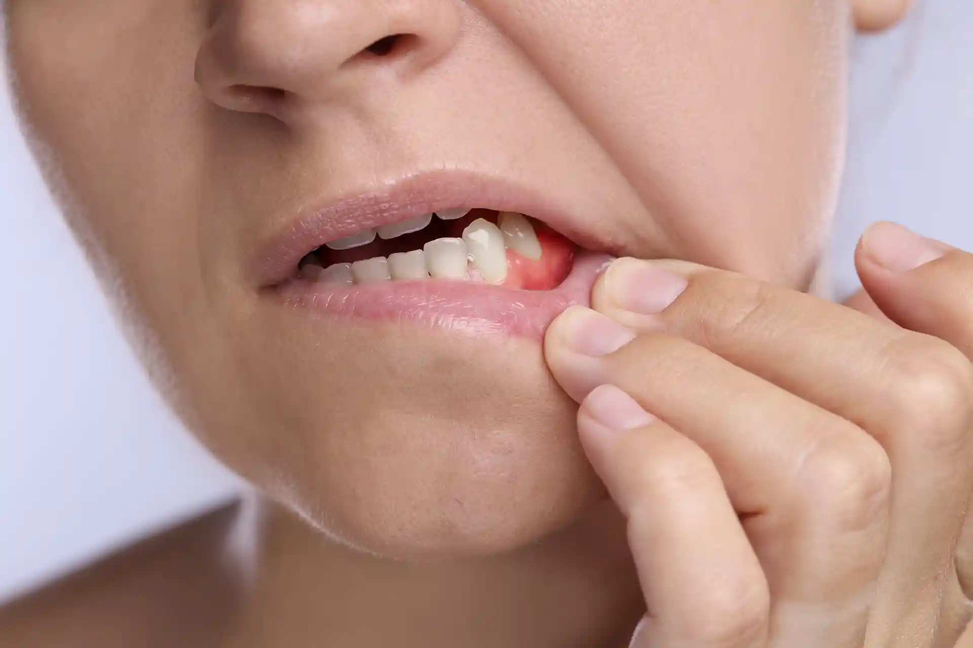 extreme close up of a woman showing swollen gums