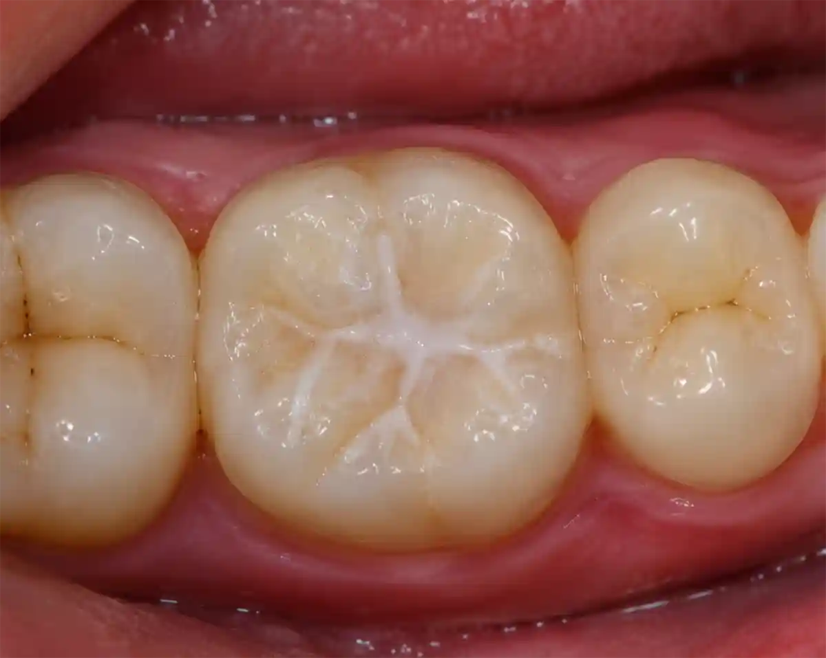 fissure sealants on tooth after treatment