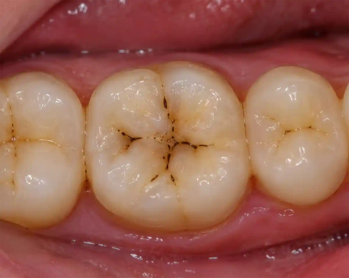 fissure sealants on tooth before treatment