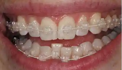 Invisalign dental treatment