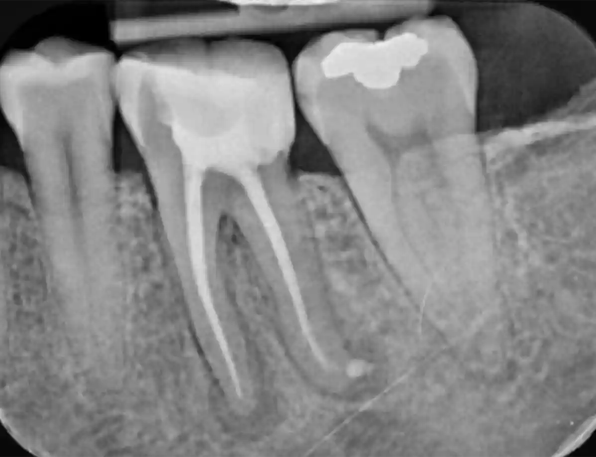 root canal after treatment