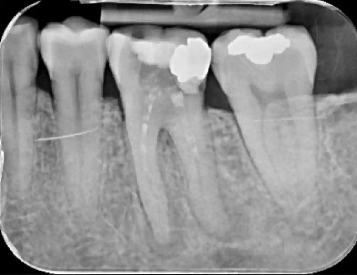 root canal before treatment