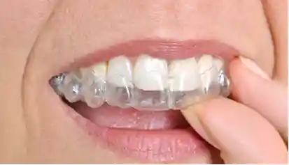 6 Month Smile dental treatment