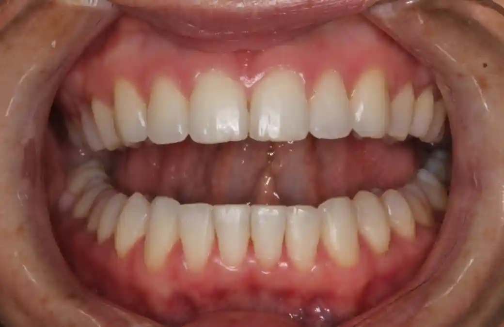 Six Month Smiles after treatment