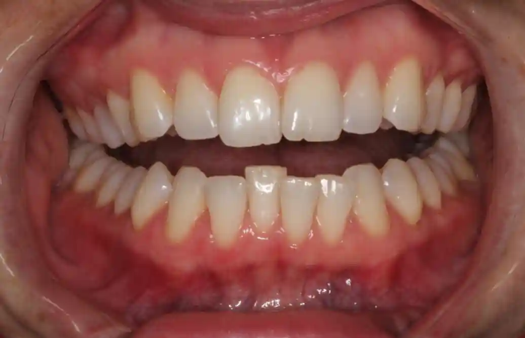 Six Month Smiles before treatment