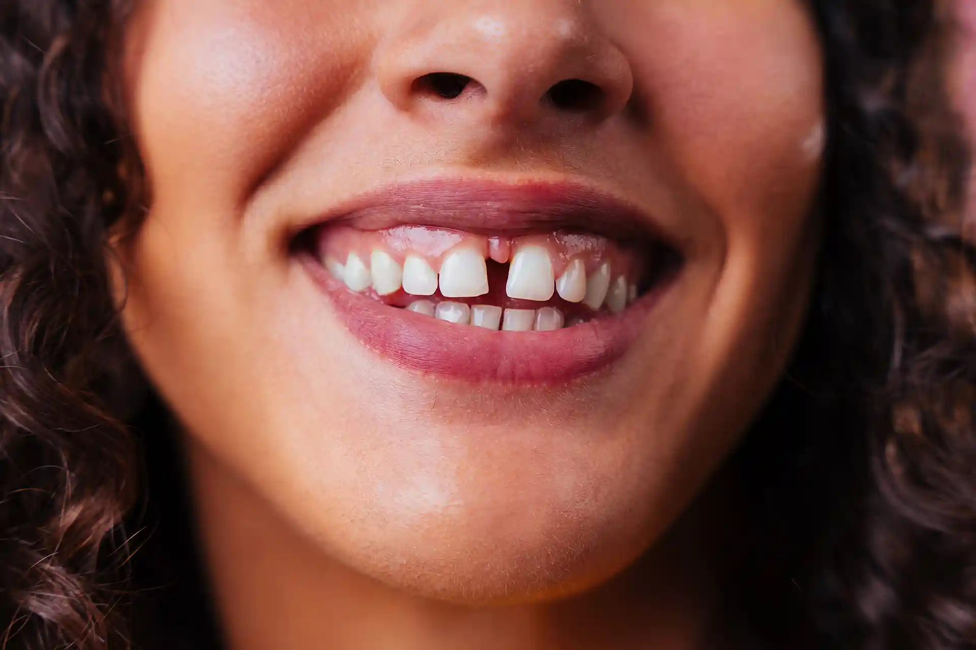 smiling woman reveals gap between her front teeth